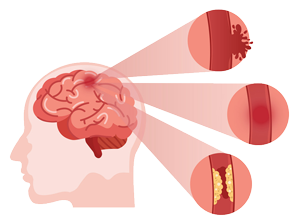 brain stroke treatment